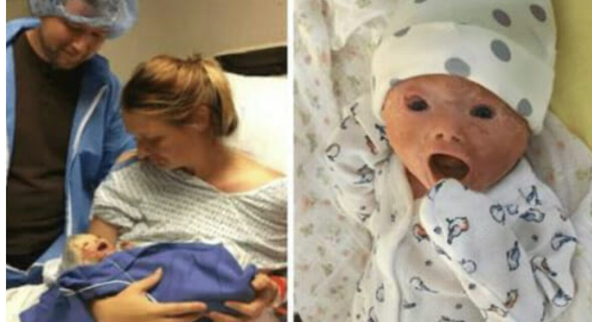 Doctors Carry Out Emergency C-Section And Deliver A Baby With A Rare Skin Condition
