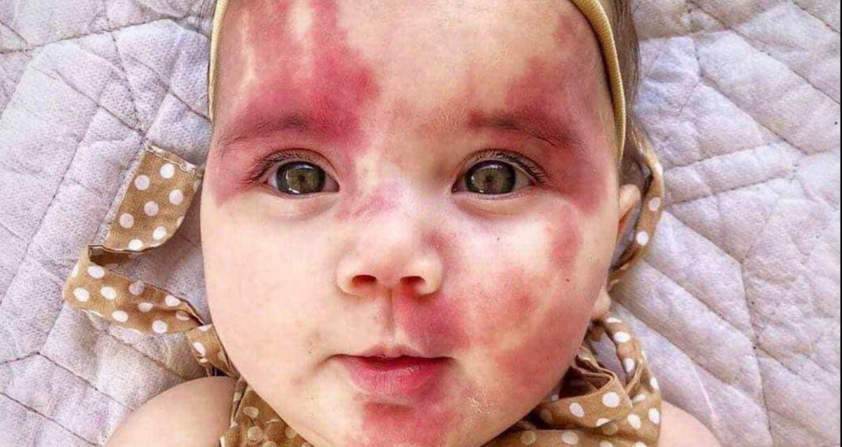 Baby Called ‘Hideous’ Is A Gorgeous Little Girl Now