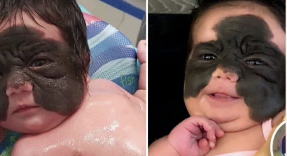 ‘Batman’ Birthmark Is Finally Removed From Girl Following Ground-Breaking Procedure