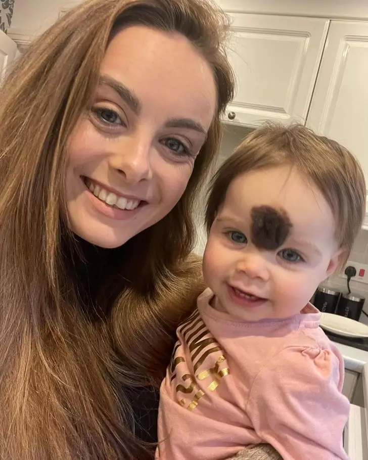 Rare Birthmark: Parents Send Their Daughter to Surgery